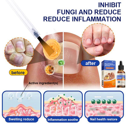 HONXI™ Bee Venom Nail Folliculitis Treatment Program: The Complete Solution to Nail Folliculitis🌟👣