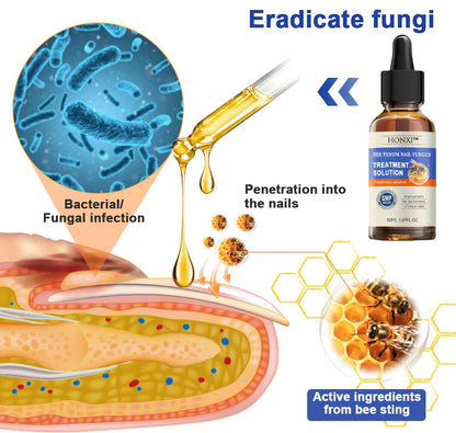 HONXI™ Bee Venom Nail Folliculitis Treatment Program: The Complete Solution to Nail Folliculitis🌟👣