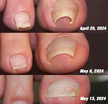 HONXI™ Bee Venom Nail Folliculitis Treatment Program: The Complete Solution to Nail Folliculitis🌟👣
