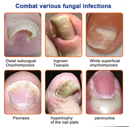 HONXI™ Bee Venom Nail Folliculitis Treatment Program: The Complete Solution to Nail Folliculitis🌟👣