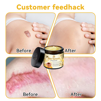 UK (MHRA Recommended) Turonu Bee Venom Treatment cream (last day promotion 80% off)