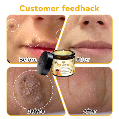 UK (MHRA Recommended) Turonu Bee Venom Treatment cream (last day promotion 80% off)