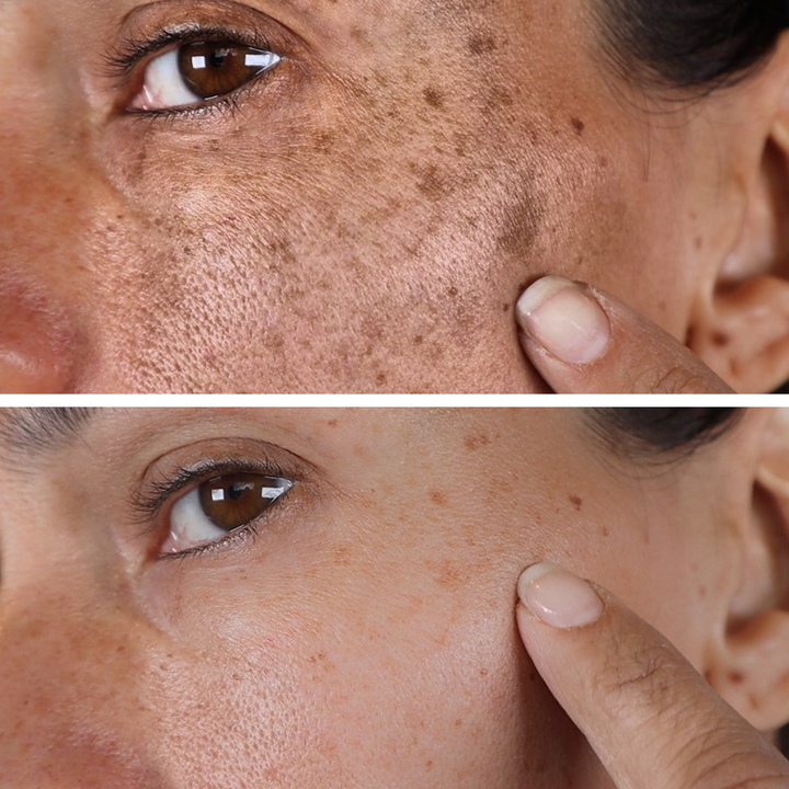 💍（LAST DAY SALE-80% OFF)Fast Dark Spot Remover-𝗖𝗼𝗼𝗹𝗼𝗿𝗱™ Melanin Correcting Brightening Serum